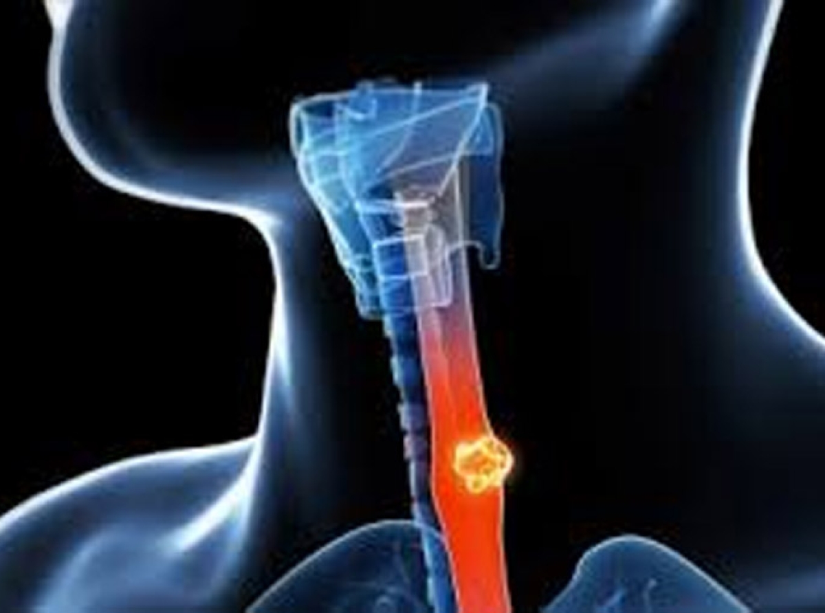 Καρκίνος του οισοφάγου : Πώς σχετίζονται τσάι και καφές