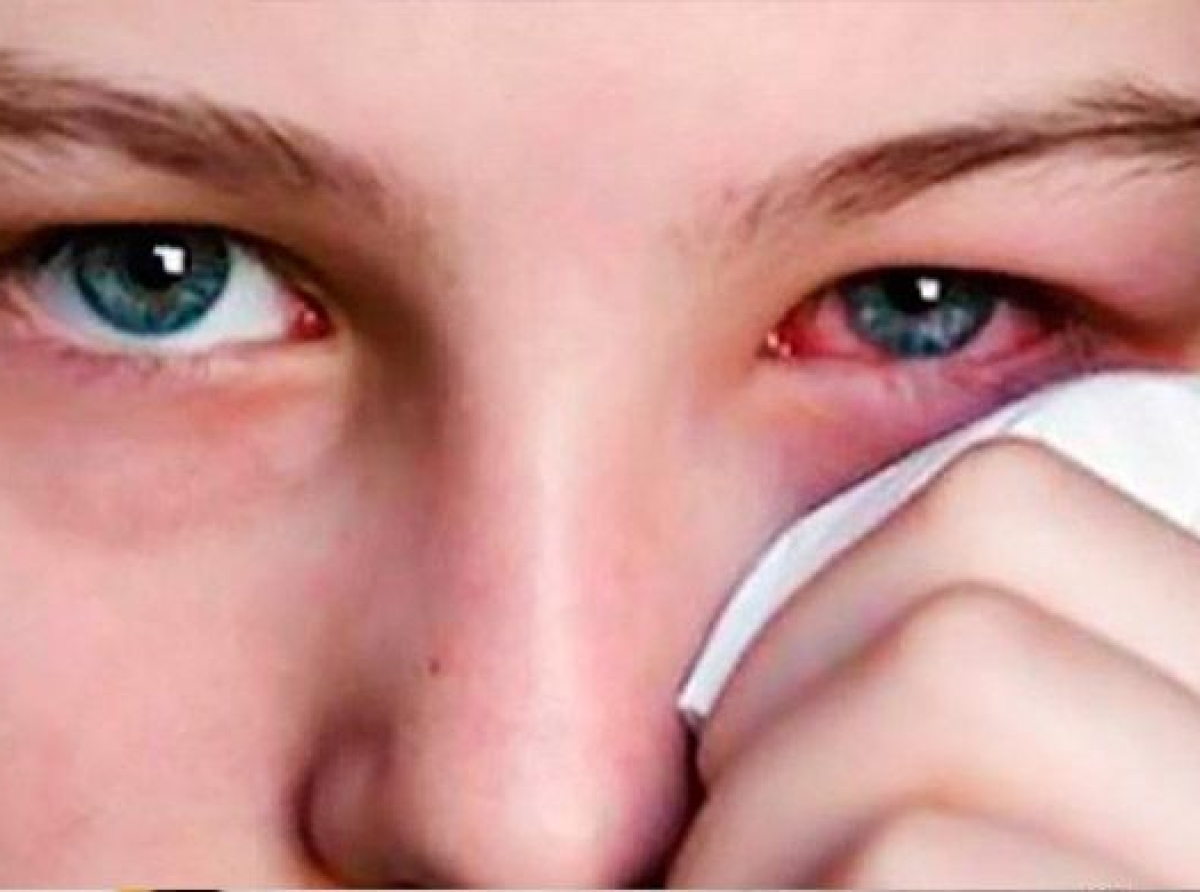 Τι προκαλεί την ερυθρότητα του ματιού και τι πρέπει να κάνετε